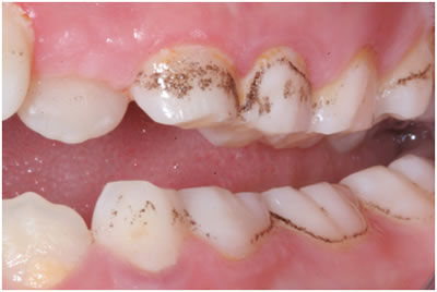 Black Stains On Teeth Near Gum Line Teethwalls